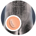 simplified image of an incisional hernia