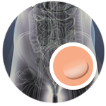 simplified image of an inguinal hernia